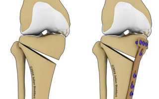 Корригирующая остеотомия коленного сустава
