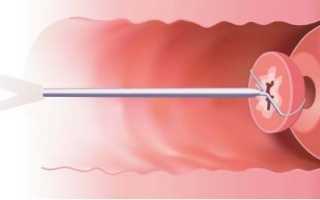 Результаты биопсии шейки матки