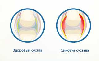 Синовит: особенности развития, причины и симптоматика