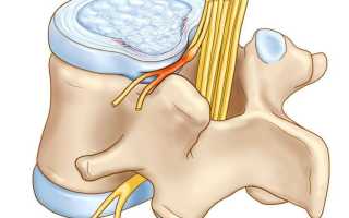 Протрузия дисков позвоночника