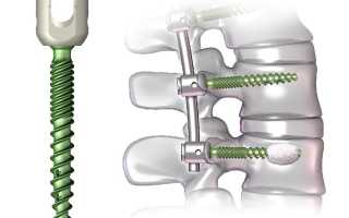 Транспедикулярная фиксация позвоночника: особенности операции