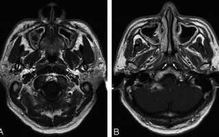 МРТ пазух носа