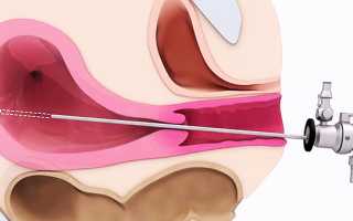 Хирургическая гистероскопия матки