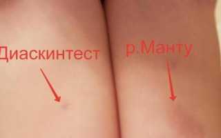 Что такое диаскин-тест