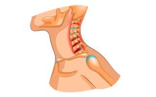 Симптомы и осложнения шейного остеохондроза