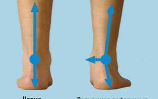 Вальгусная деформация стопы: как лечить