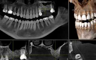 Всё, что вы хотели знать о КТ зубов