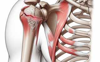 Перелом большого бугорка плечевой кости: полный обзор