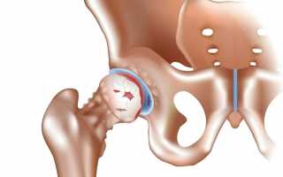 Лечение хруста тазобедренного сустава