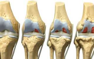 Остеоартроз коленного сустава