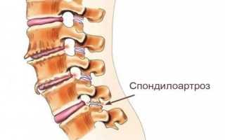 Спондилоартроз пояснично-крестцового отдела позвоночника