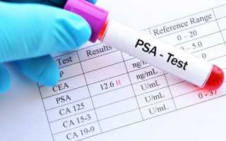ПСА при аденоме простаты