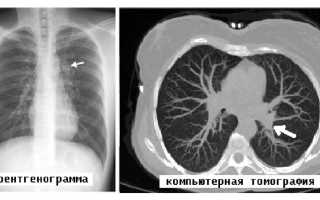 Туберкулез на компьютерной томографии: варианты и их проявления