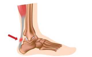 Воспалительные процессы ахиллова сухожилия