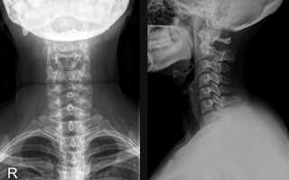 Рентген (рентгенография) шейного отдела позвоночника
