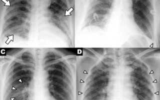 Рентген легких при пневмонии