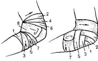 Техника наложения черепашьей повязки на локтевой сустав