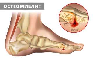 Остеомиелит кости: все, что нужно знать о заболевании