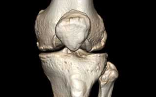 Чем отличается КТ от МРТ коленного сустава?