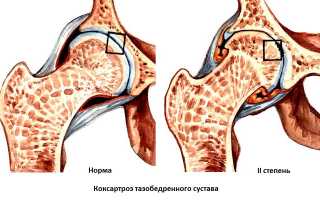 Коксартроз 2 степени: что делать?