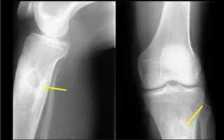 Остеомиелит кости на рентгене