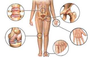 Полиостеоартроз: виды, риски развития и методы лечения