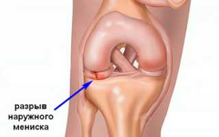 Разрыв мениска коленного сустава