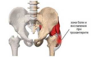 Трохантерит тазобедренного сустава