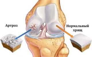 Артроз и остеоартроз: в чем разница?