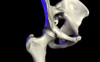 Какой врач лечит коксартроз тазобедренного сустава
