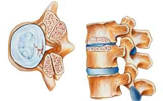 Протрузия межпозвоночных дисков пояснично-крестцового отдела