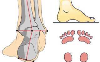 Устранение пяточно-варусной или пяточно-супинационной деформации стопы