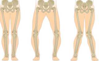 Лечение вальгусной деформации бедренной кости