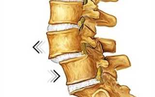 Что такое спондилолистез?