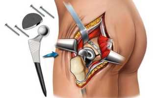 Эндопротезирование тазобедренного сустава